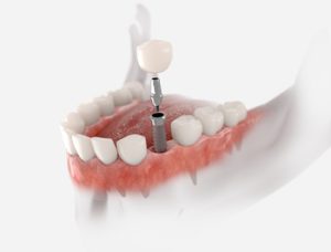 Cheapest-Dental-Implants-In-Australia-illustration-campbelltown