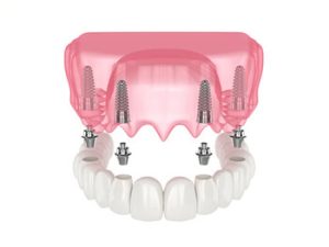 all 4 dental implants illustration campbelltown