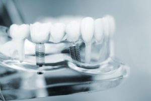 Cost Of Single Tooth Implants illustration campbelltown