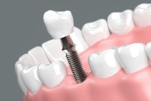 Dental Insurance That Covers Implants materials campbelltown