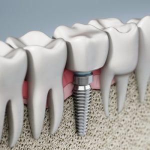 out of the country dental implants campbelltown