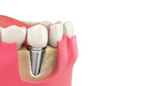 tooth implant overseas campbelltown