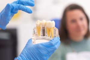 Dental Implant Cost in Kuala Lumpur consult