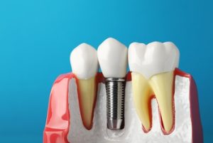 Dental Implant Cost in Kuala Lumpur illustration
