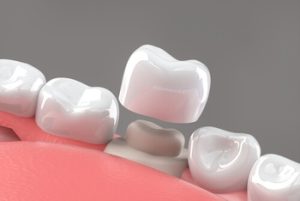 What Does a Crown Look Like on a Tooth cap