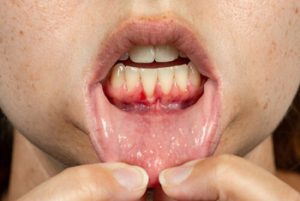 How to Get Rid of Bad Breath gum disease