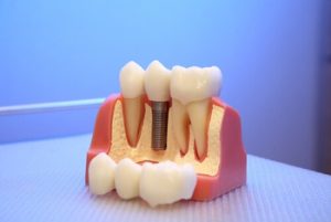 My Front Tooth is Loose What Can I Do implant