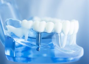 why no dairy after dental implant illustration